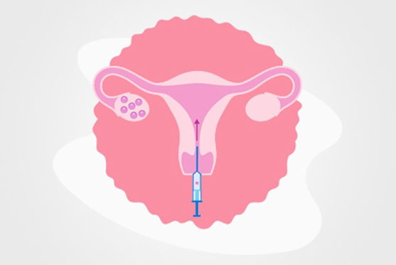 Frozen Embryo Transfer