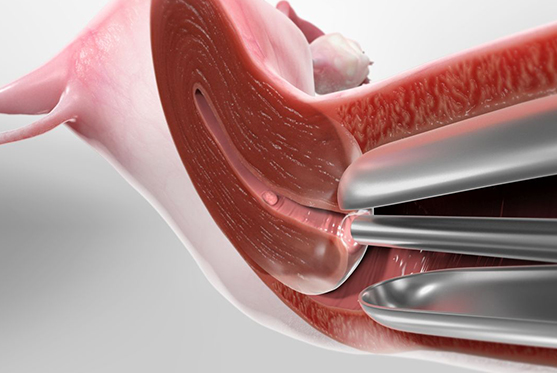 Hysteroscopy