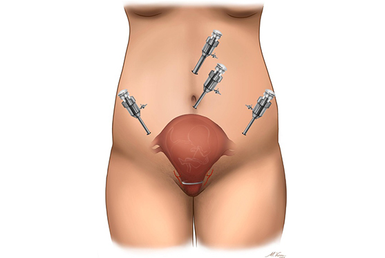 Laparoscopic Cerclage