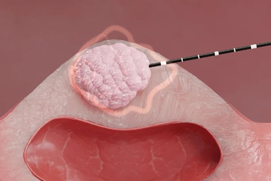 Microwave Ablation (MWA) for Adenomyosis