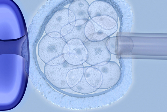 PGT-M (Preimplantation Genetic Testing for Monogenic Diseases)